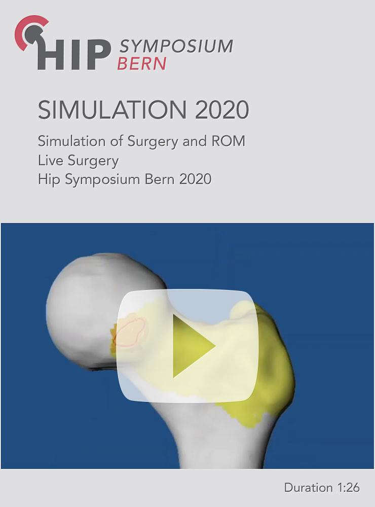 Simulation of Surgery and ROM Live Surgery Case HSB 2020