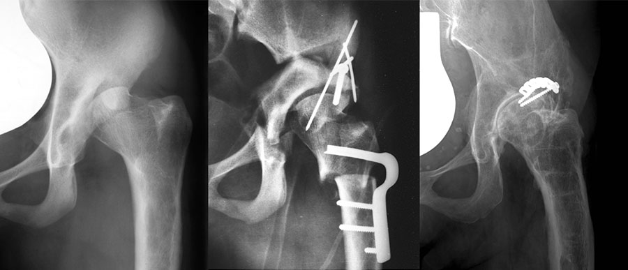First case of periacetabular osteotomy (PAO)