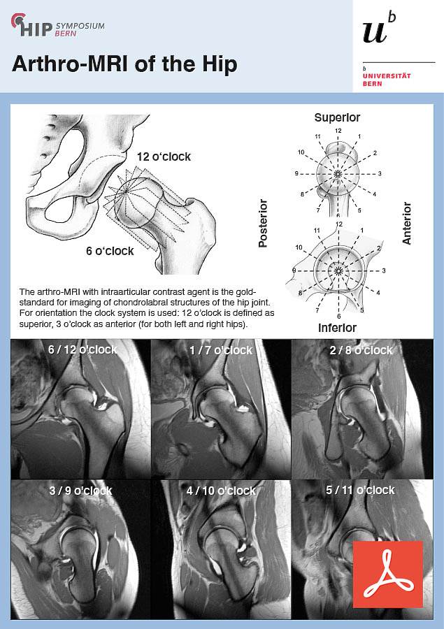 Arthro-MRI of the Hip