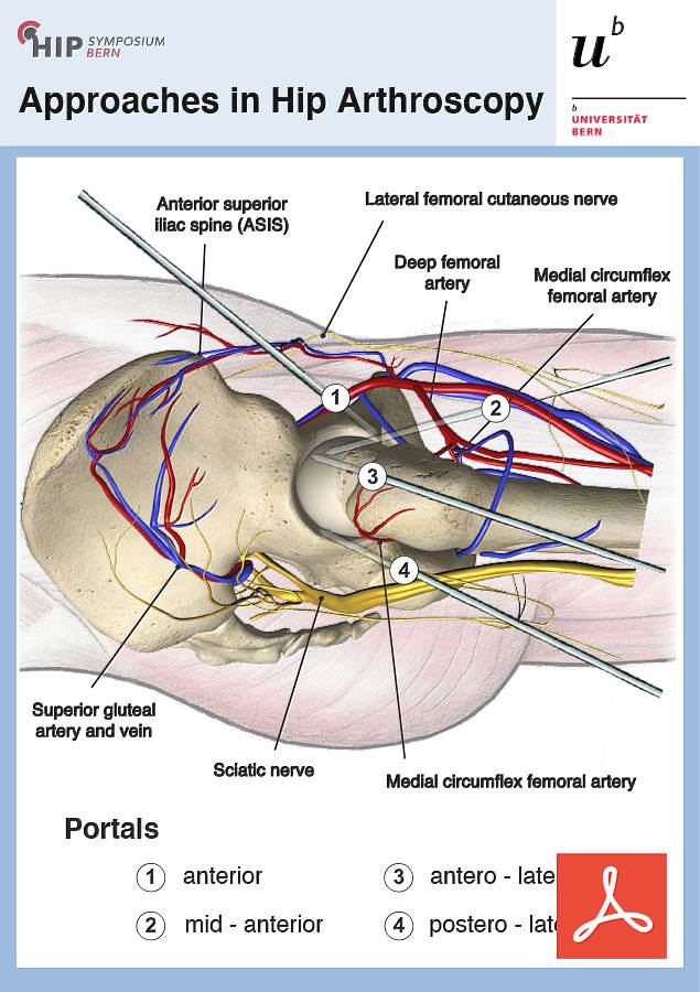 Approaches in Hip Arthroscopy