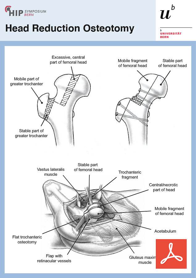 Head Reduction Osteotomy