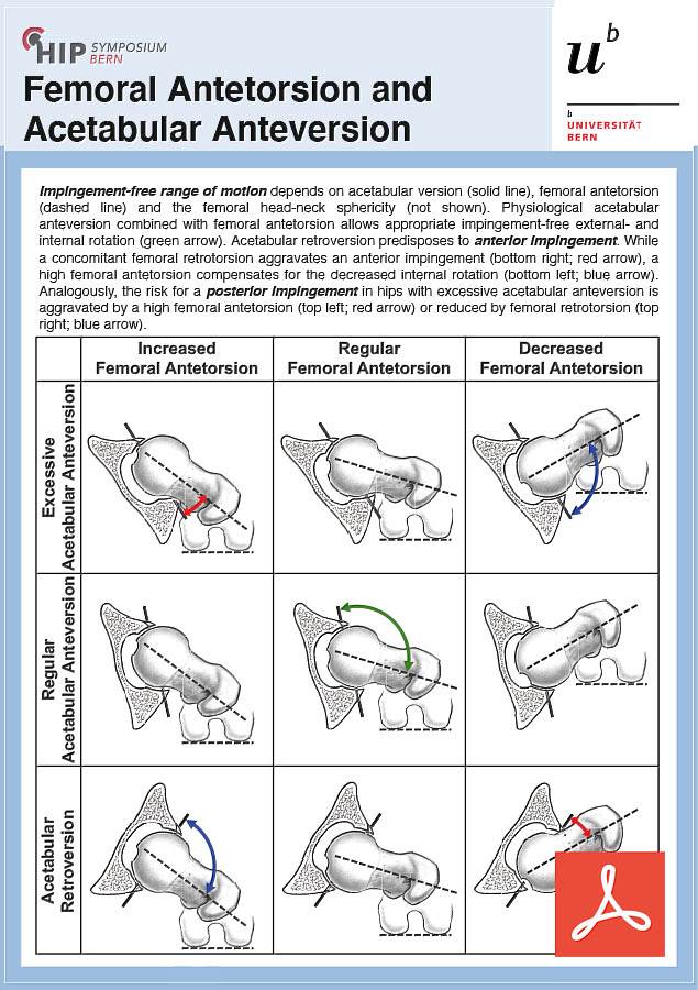 Femoral Antetorsion and Acetabular Anteversion