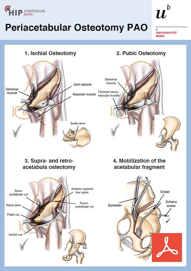 Periacetabular Osteotomy PAO