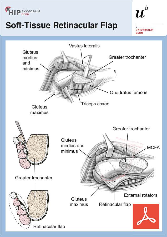 Soft-Tissue Retinacular Flap