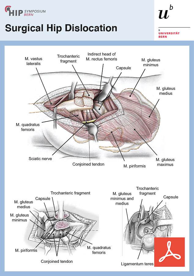 Surgical Hip Dislocation