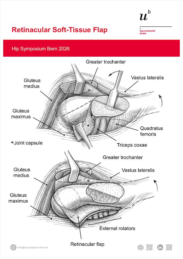 Poster Retinacular Flap 2 Hip Symposium 2026