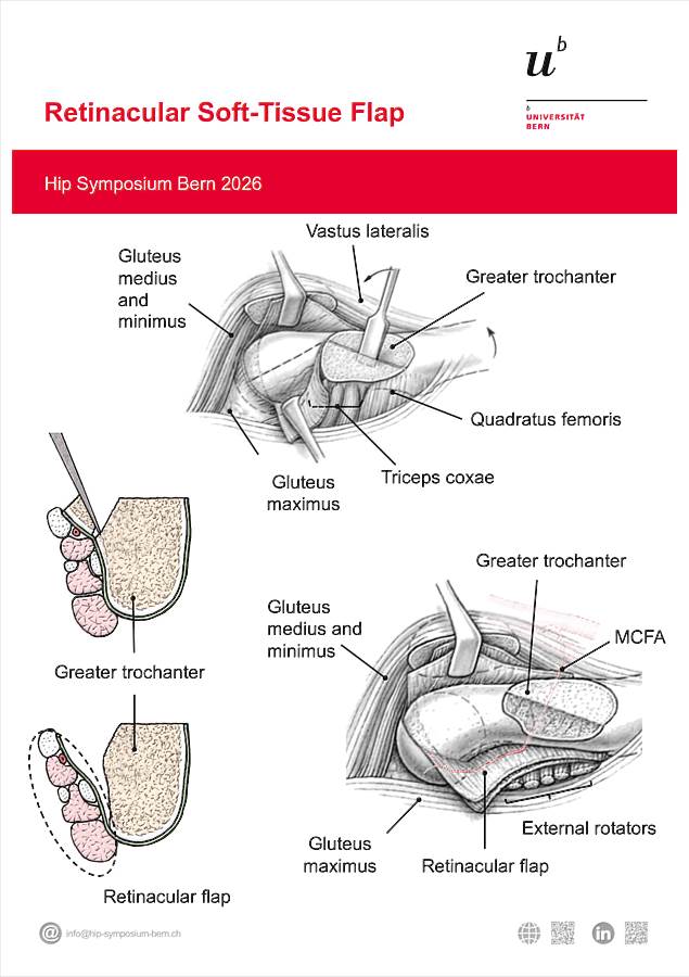 Poster Retinacular Flap Hip Symposium 2026