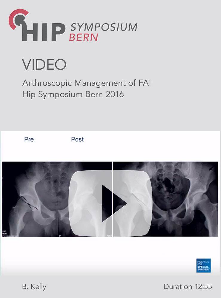 B. Kelly - Arthroscopic Management of FAI - Hip Symposium 2016