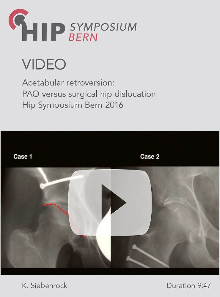 K. Siebenrock - Acetabular retroversion: PAO versus surgical hip dislocation - Hip Symposium 2016