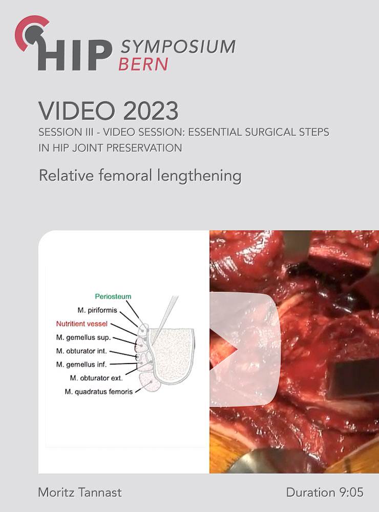 Relative femoral lengthening | Moritz Tannast (Session 3)