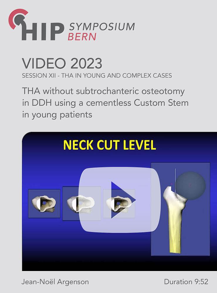 THA without subtrochanteric osteotomy in DDH using a cementless Custom Stem in young patients | Argenson Jean-Noël (Session 12)