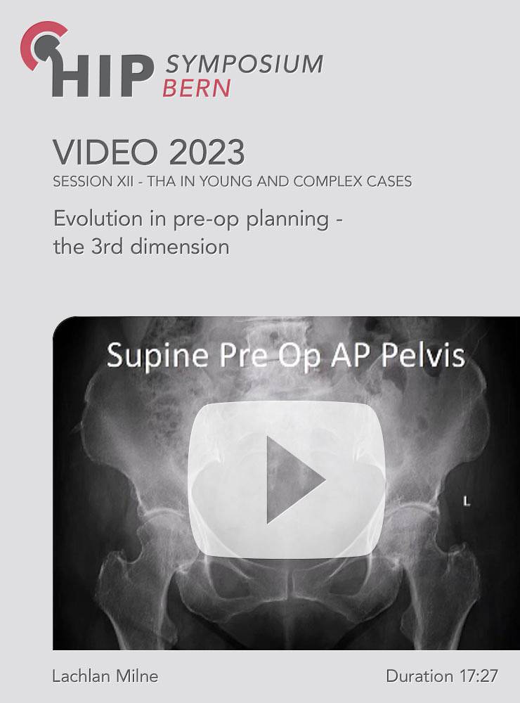 Evolution in pre-op planning- the 3rd dimension | Milne Lachlan (Session 12)