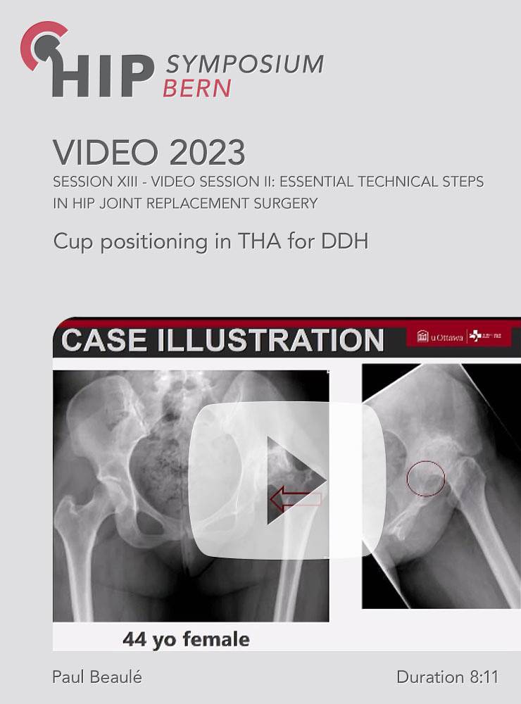 Video Hip Symposium 2023 S13 5 Beaule