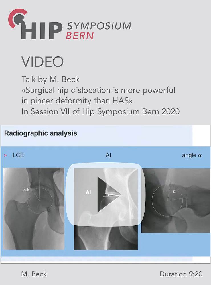 Surgical hip dislocation is more powerful in pincer deformity than HAS / M. Beck