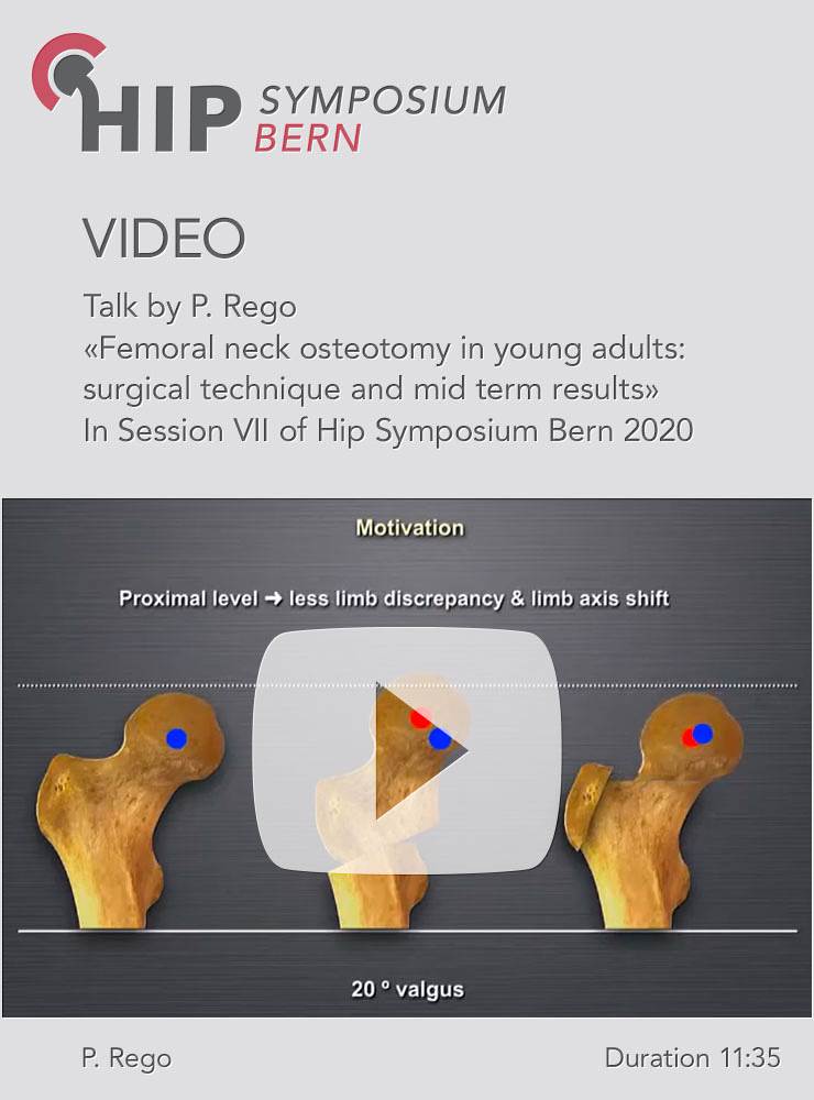 Femoral neck osteotomy in young adults: surgical technique and mid term results / P. Rego